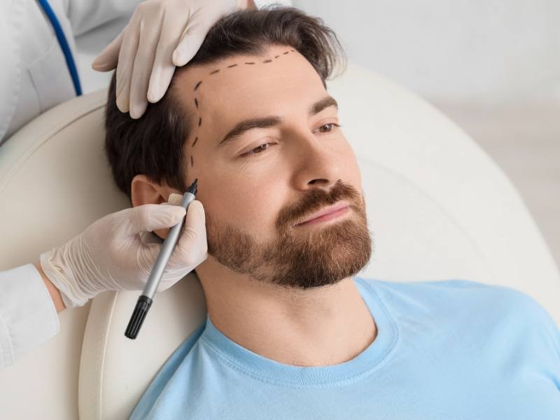 Transplante Capilar FUE: antes e depois, resultados reais e cronograma de crescimento