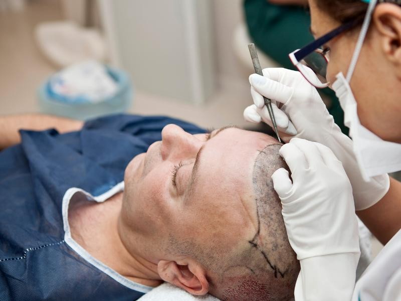 Tudo o Que Você Precisa Saber Antes de Fazer um Transplante Capilar