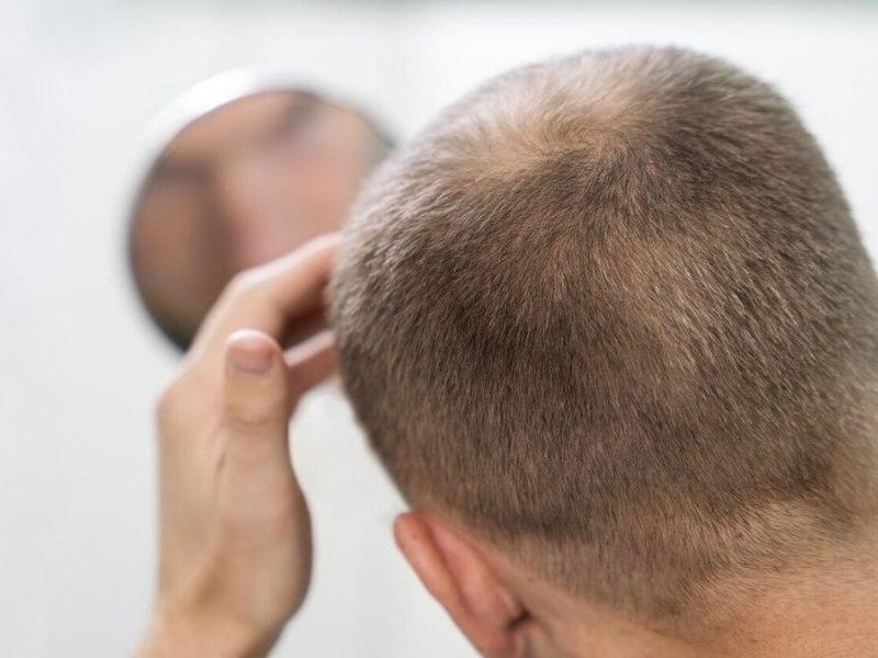 Como a terapia combinada acelera o resultado do transplante capilar