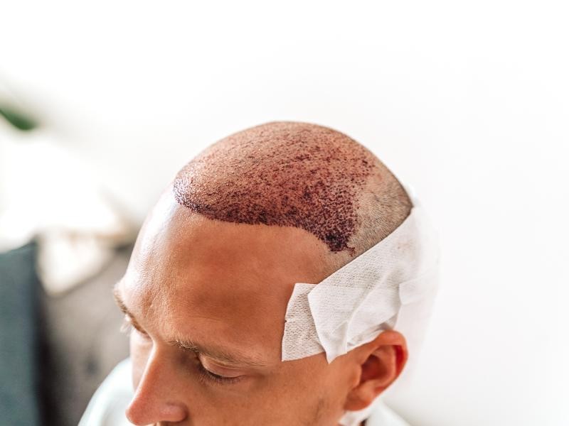 Transplante Capilar com Resultado Natural: O Que Faz a Diferença?
