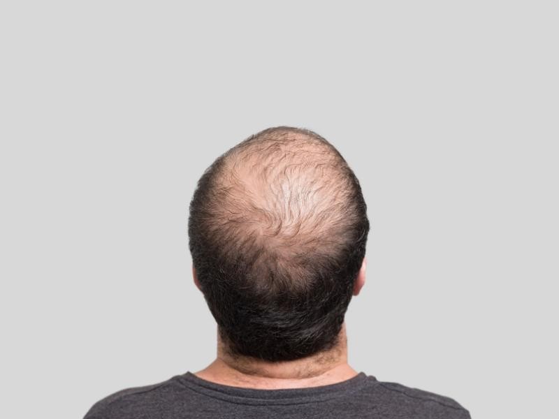 Calvície Tem Cura? O Que Realmente Funciona e o Que é Pura Ilusão